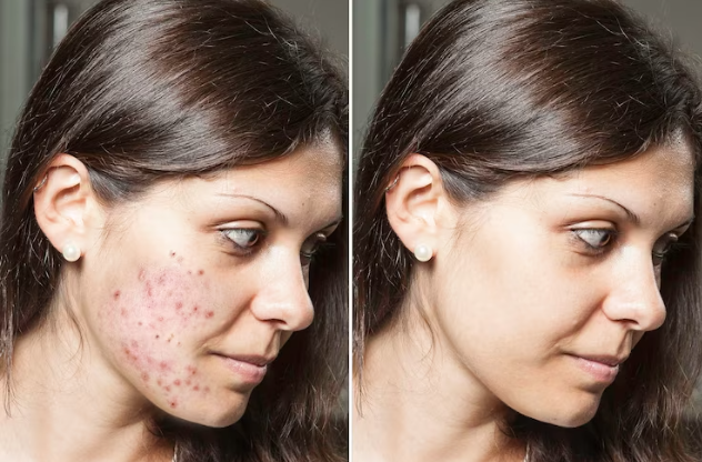 Hyperpigmentation Tretinoin Before And After